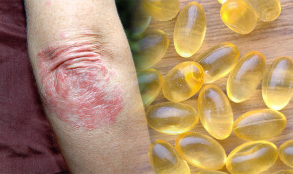 Psoriasis Treatment