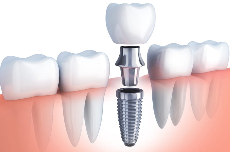 dental implants singapore