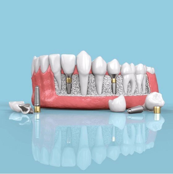 Dentist Supports